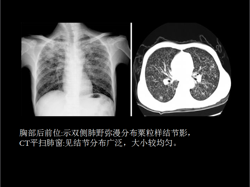 呼吸系统疾病X线诊断