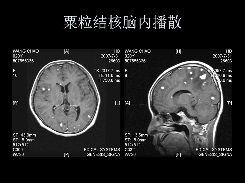 呼吸系统疾病X线诊断