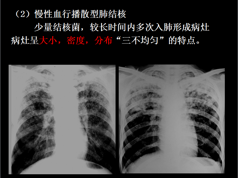 呼吸系统疾病X线诊断