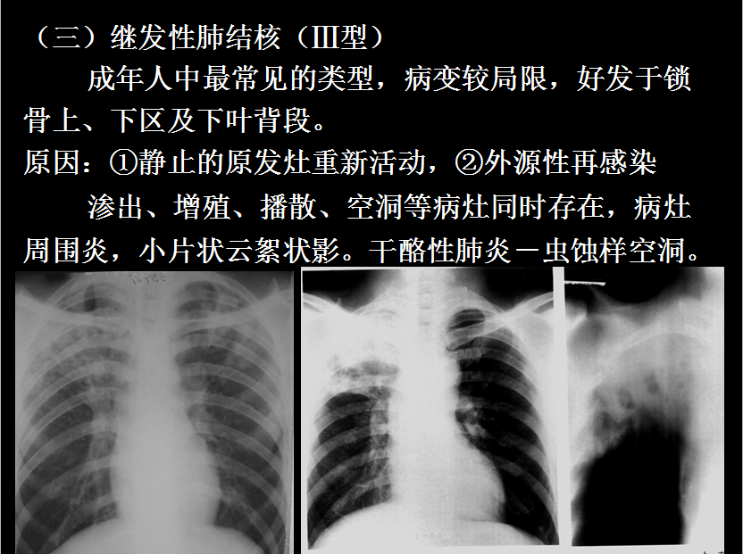 呼吸系统疾病X线诊断
