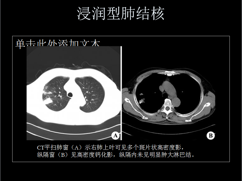 呼吸系统疾病X线诊断