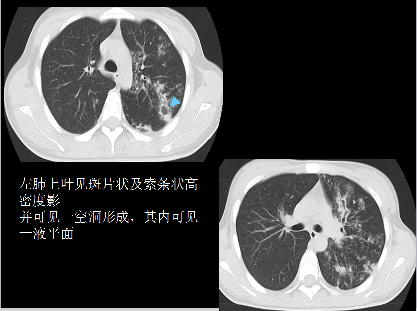 呼吸系统疾病X线诊断