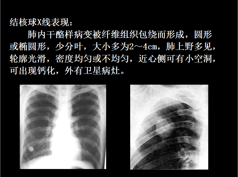 呼吸系统疾病X线诊断