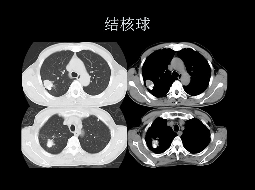呼吸系统疾病X线诊断