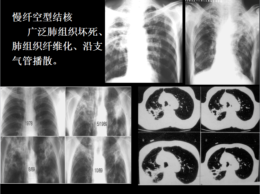 呼吸系统疾病X线诊断