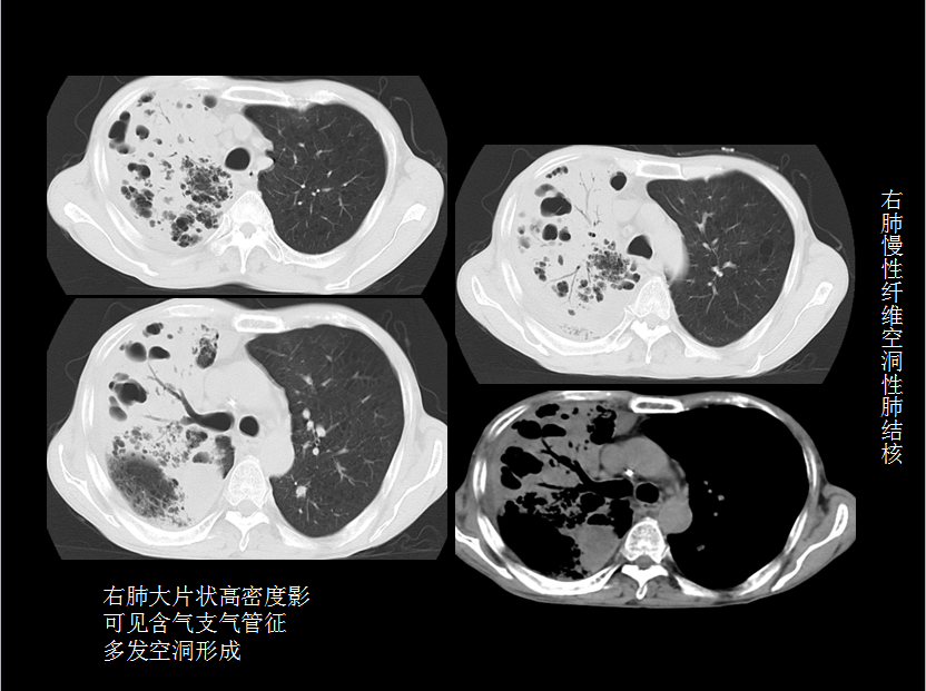 呼吸系统疾病X线诊断