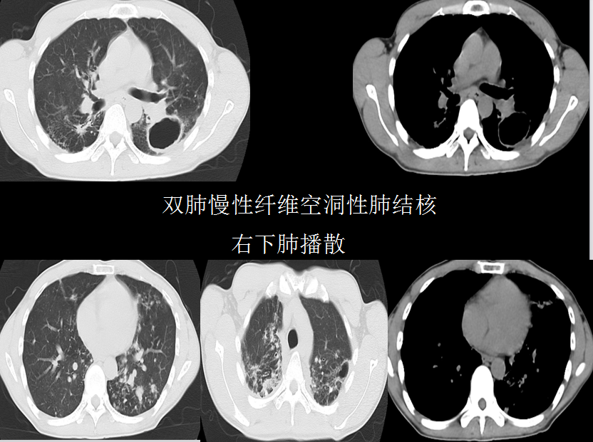 呼吸系统疾病X线诊断