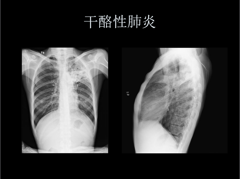 呼吸系统疾病X线诊断