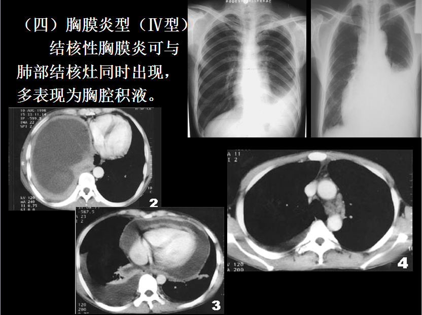 呼吸系统疾病X线诊断