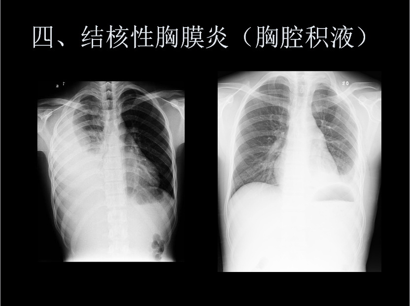 呼吸系统疾病X线诊断