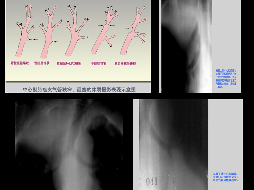 呼吸系统疾病X线诊断