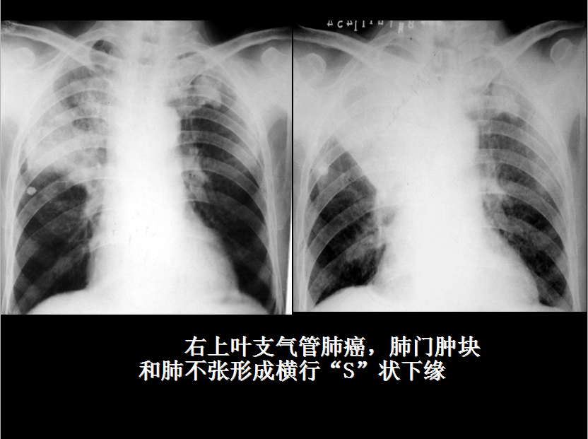 呼吸系统疾病X线诊断