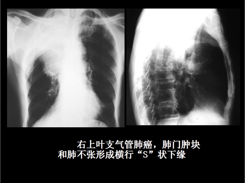 呼吸系统疾病X线诊断