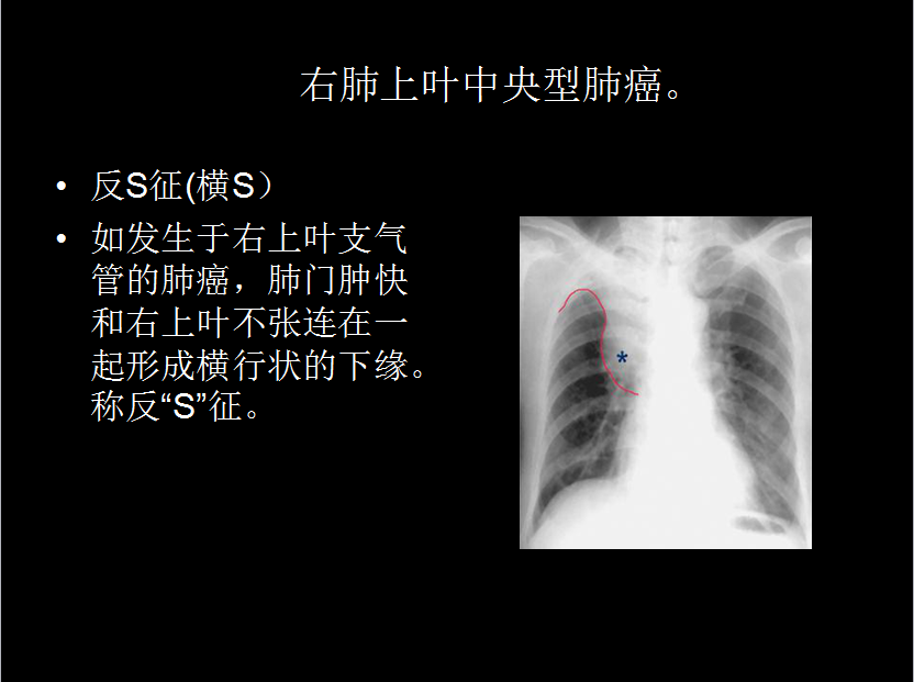 呼吸系统疾病X线诊断