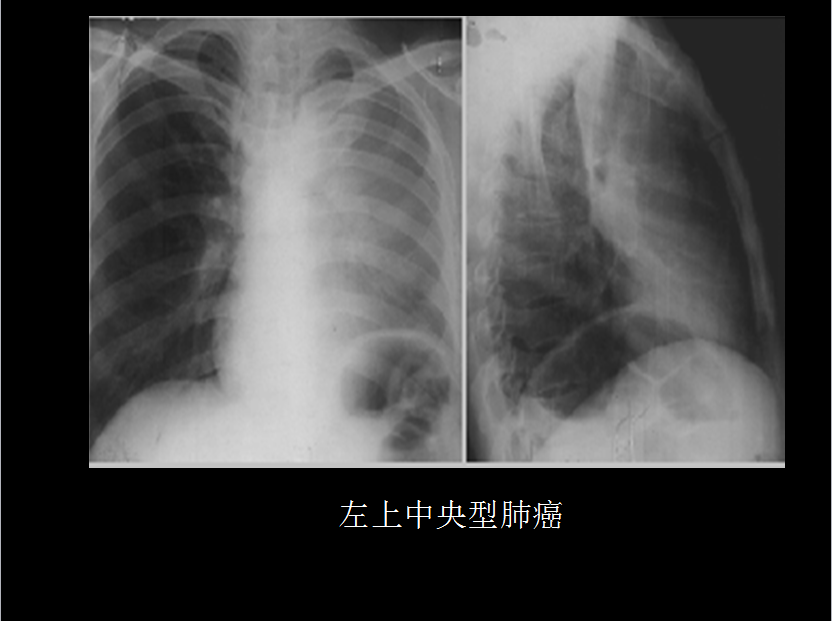呼吸系统疾病X线诊断
