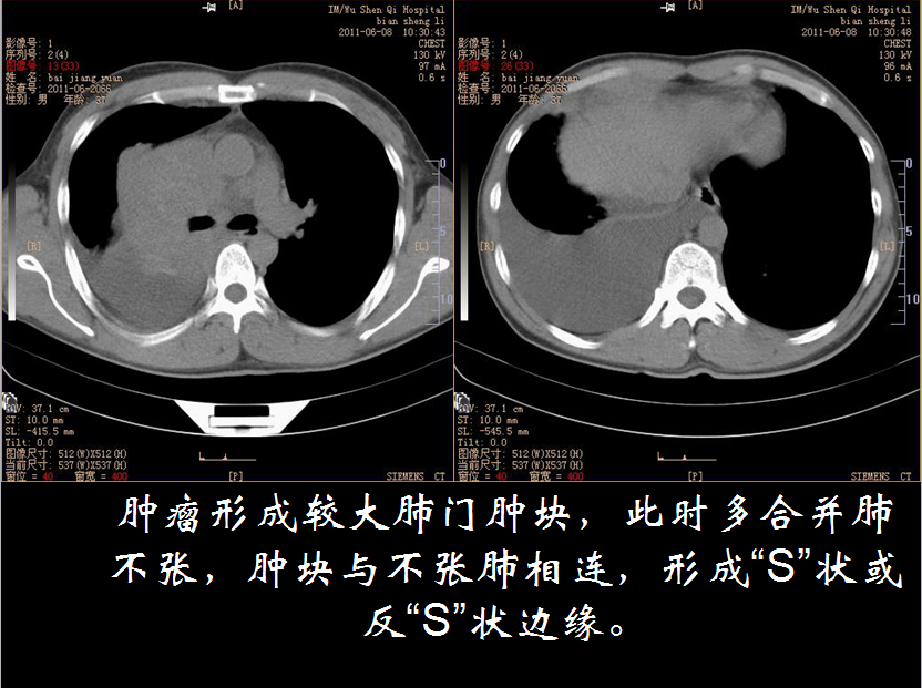 呼吸系统疾病X线诊断