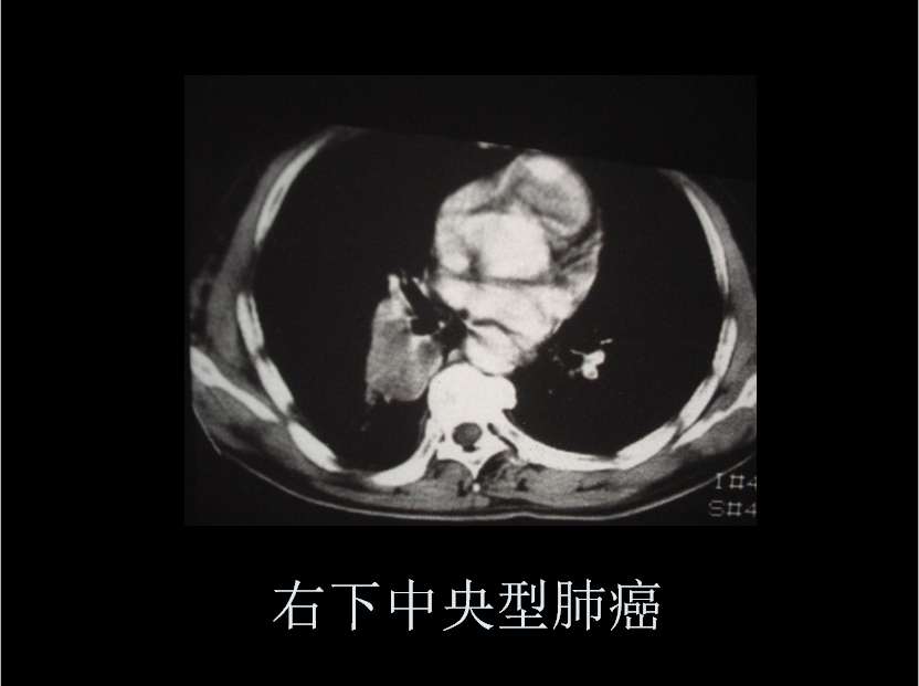 呼吸系统疾病X线诊断