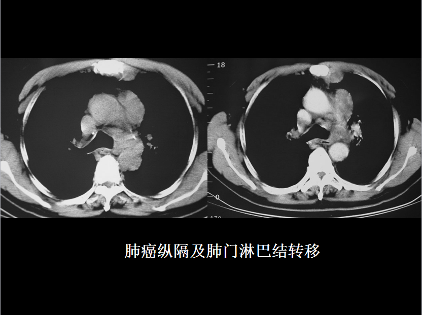呼吸系统疾病X线诊断