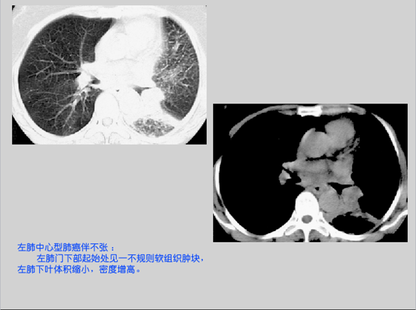 呼吸系统疾病X线诊断