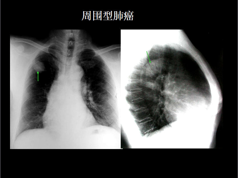 呼吸系统疾病X线诊断