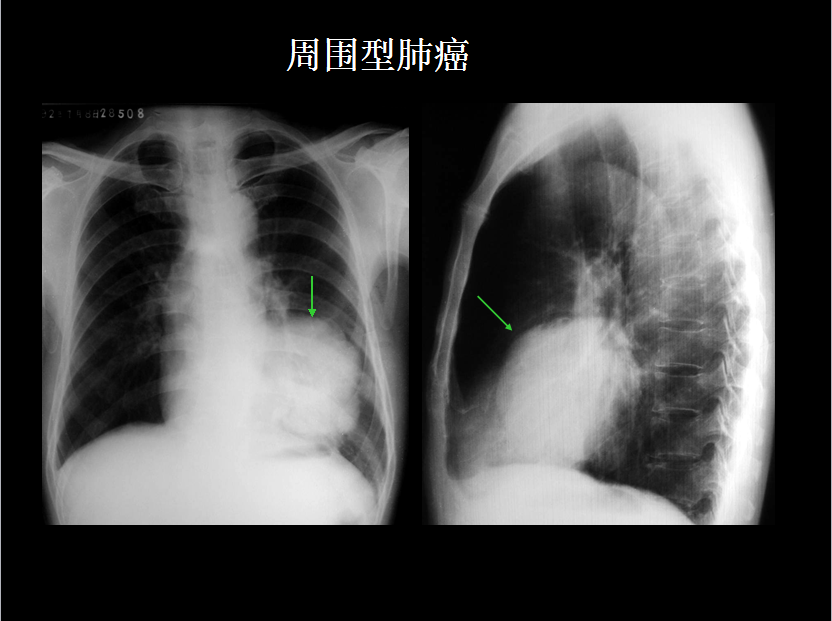呼吸系统疾病X线诊断