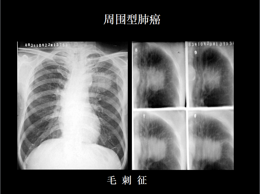 呼吸系统疾病X线诊断