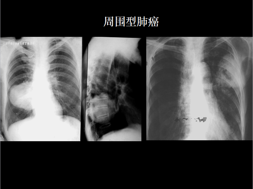 呼吸系统疾病X线诊断