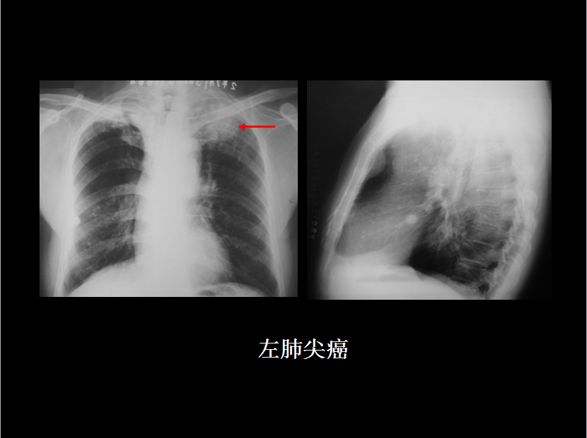 呼吸系统疾病X线诊断