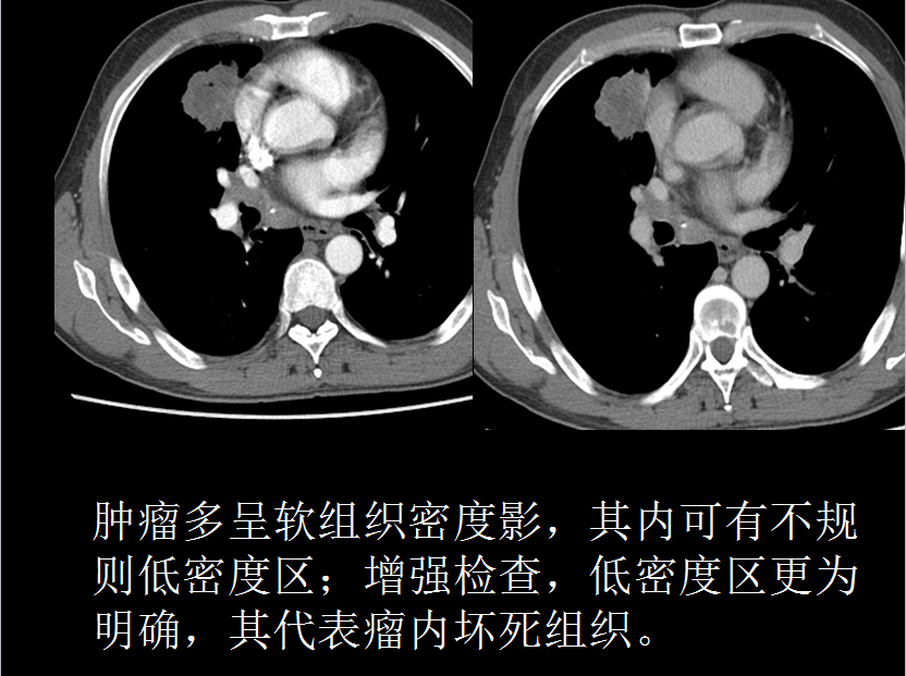 呼吸系统疾病X线诊断