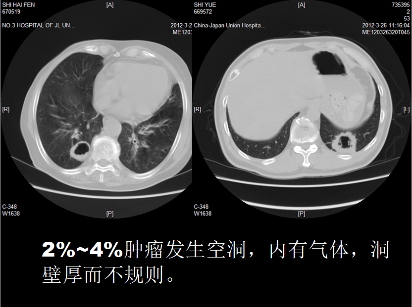 呼吸系统疾病X线诊断
