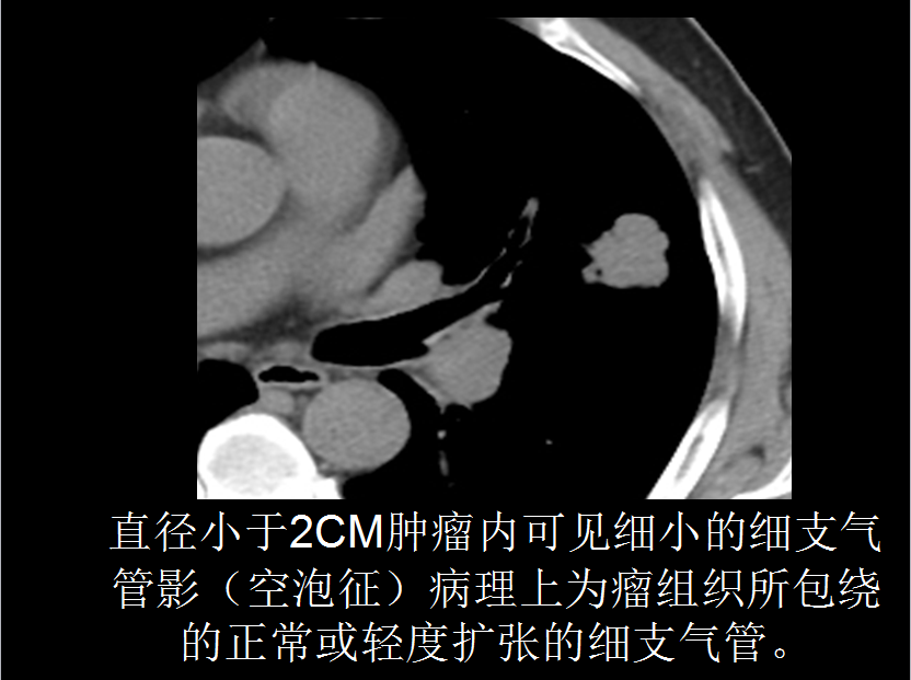 呼吸系统疾病X线诊断
