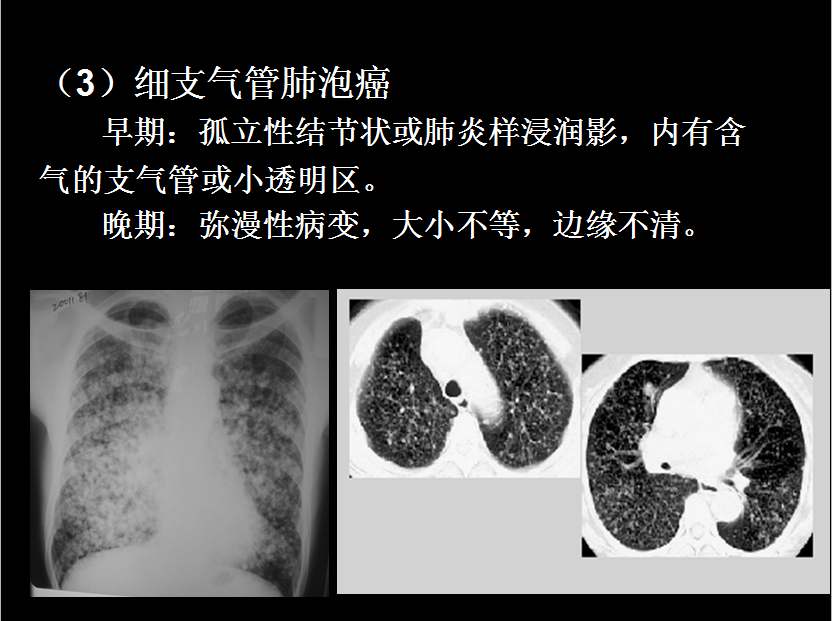 呼吸系统疾病X线诊断