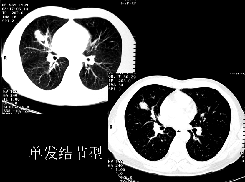 呼吸系统疾病X线诊断