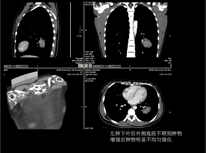 呼吸系统疾病X线诊断