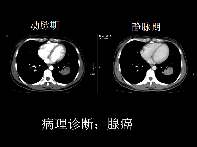 呼吸系统疾病X线诊断