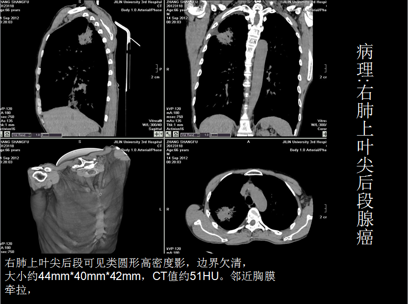 呼吸系统疾病X线诊断