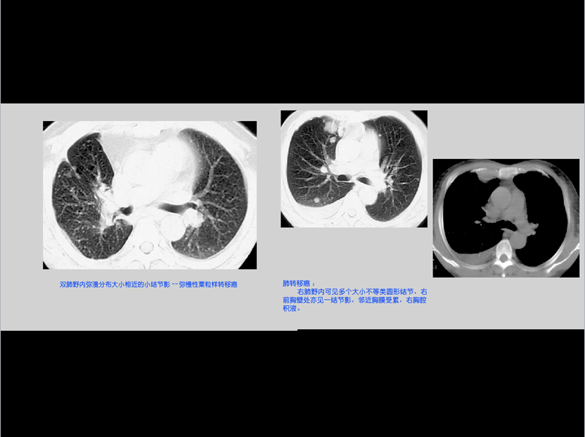 呼吸系统疾病X线诊断