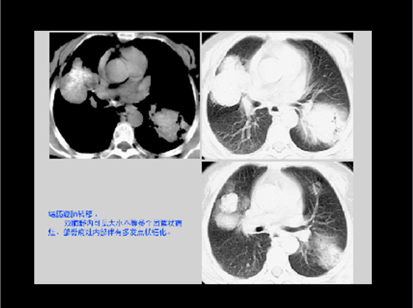 呼吸系统疾病X线诊断