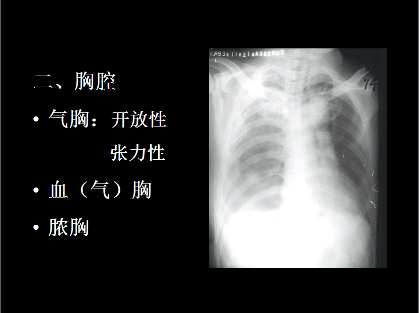 呼吸系统疾病X线诊断