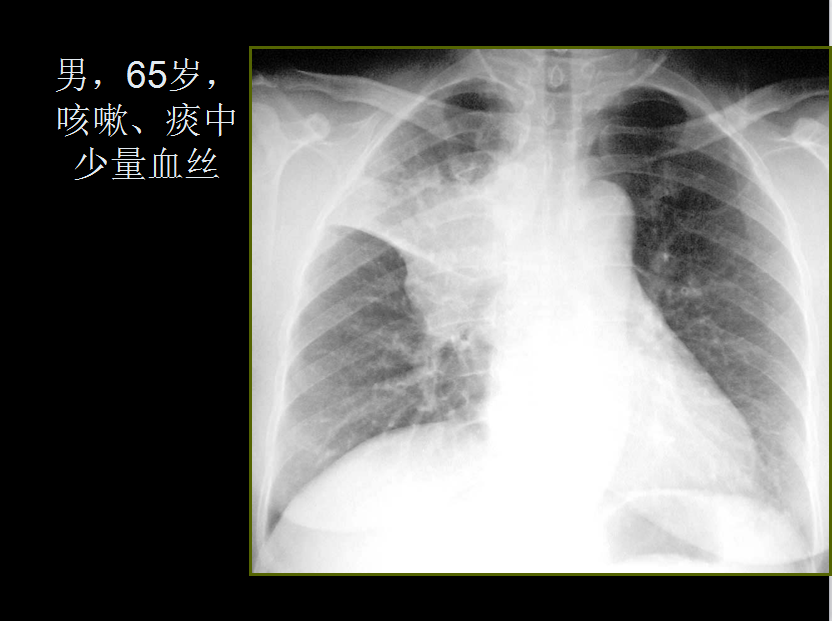 呼吸系统疾病X线诊断