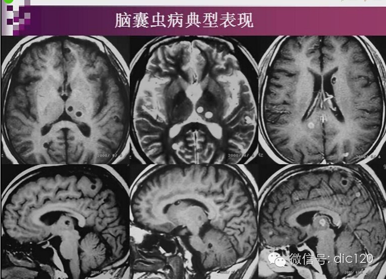 脑内环形强化病变影像诊断思路