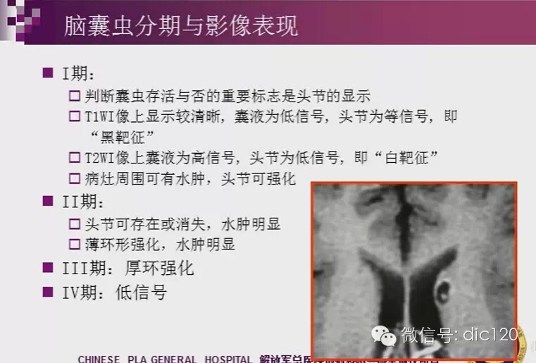 脑内环形强化病变影像诊断思路