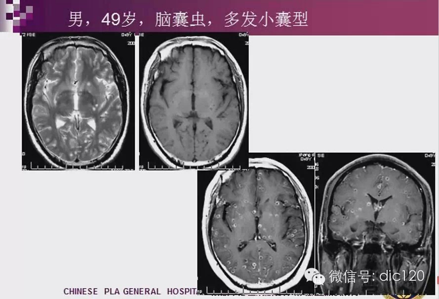 脑内环形强化病变影像诊断思路