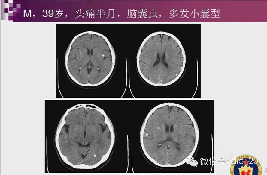 脑内环形强化病变影像诊断思路