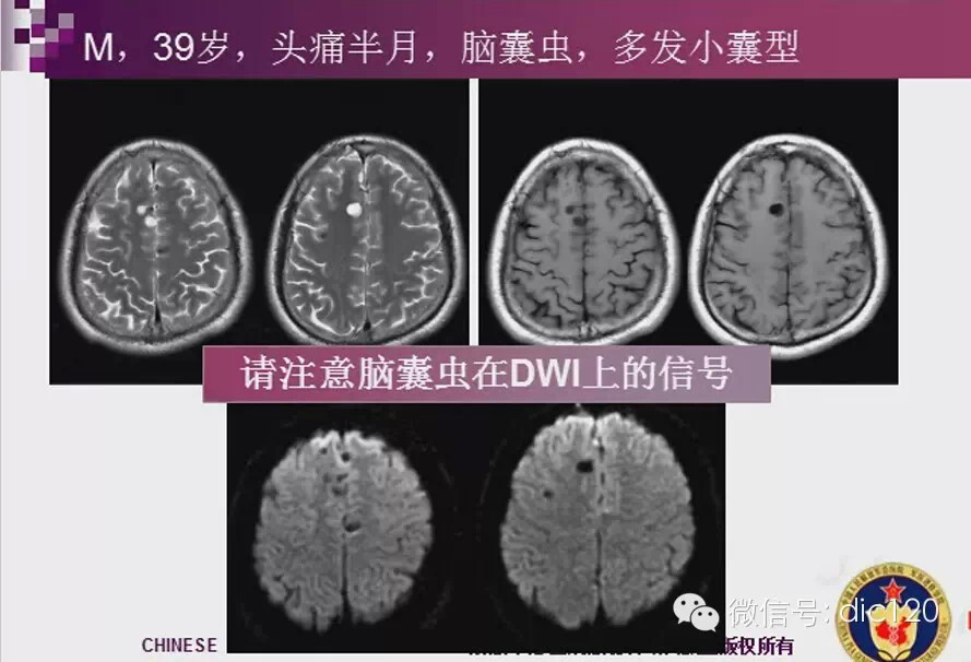 脑内环形强化病变影像诊断思路