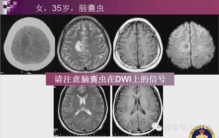 脑内环形强化病变影像诊断思路