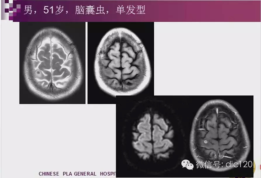 脑内环形强化病变影像诊断思路