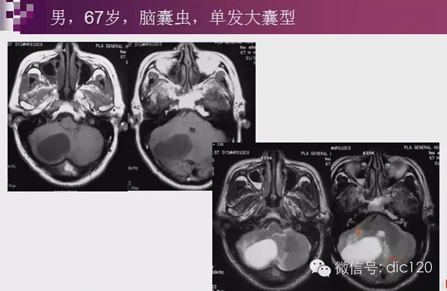 脑内环形强化病变影像诊断思路