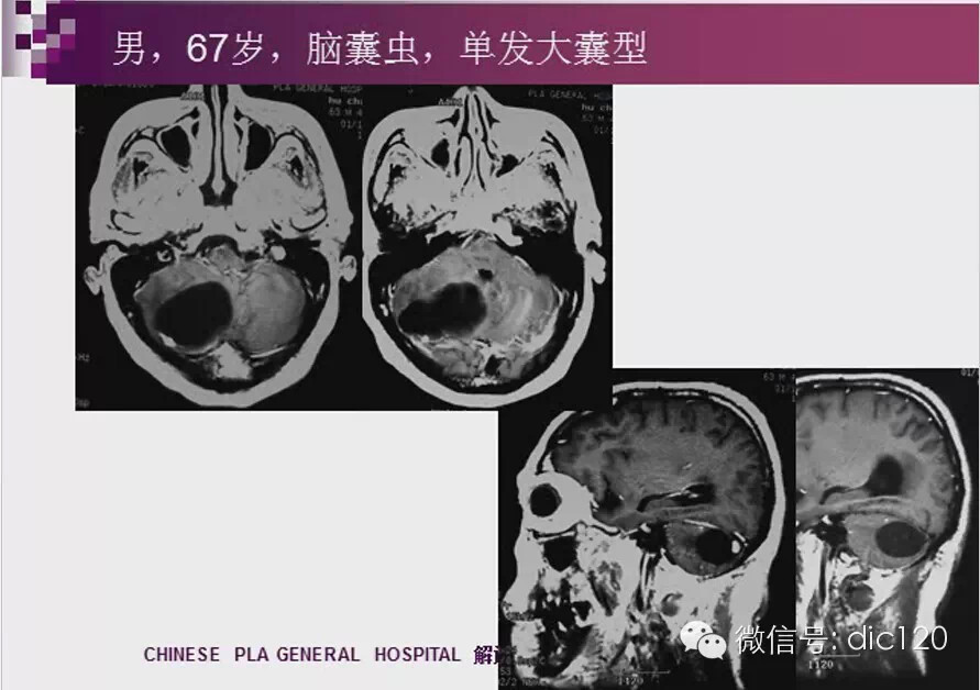 脑内环形强化病变影像诊断思路