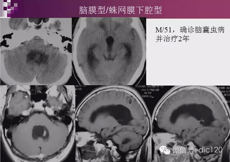 脑内环形强化病变影像诊断思路